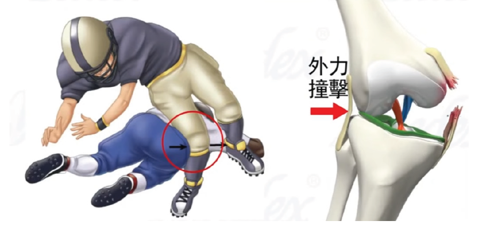 Collateral Ligament Injury Mechanism